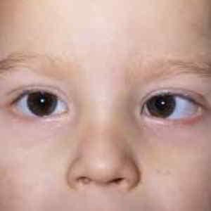 Síndrome de Duane El Síndrome de Duane es un desorden del movimiento ocular. Esta condición impide el movimiento del ojo hacia la oreja.