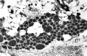 que con el grupo de Fukuyama formarían el conjunto de distrofias musculares congénitas asociadas a síndromes lisencefálicos cobblestone [6]. Distrofia muscular congénita progresiva.