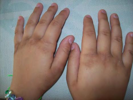 Foto 1: Vista de las lesiones en ambas manos. Foto 2: Imagen de los pliegues engrosados lineal de la piel de las manos.