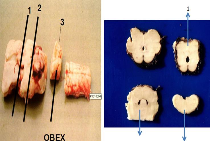 DIAGNOSTICO Clínico Histopatología del Obex (primera porción de la medula