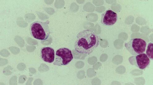 Leucemia de linfocitos