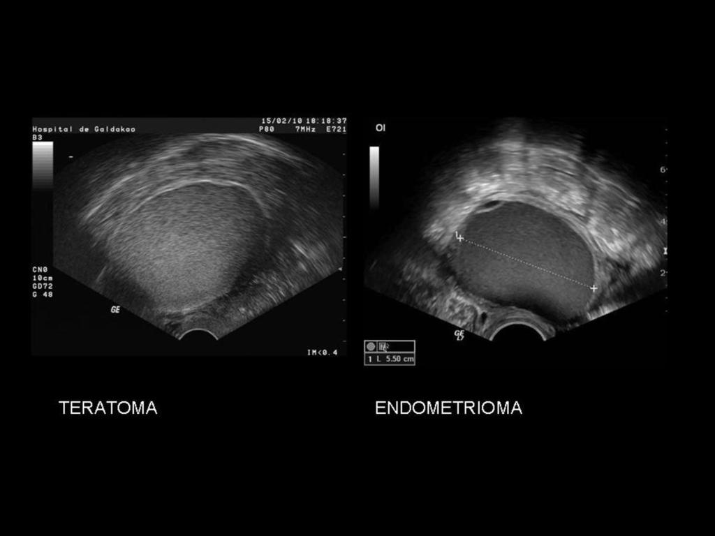 Fig. 14: DD: endometrioma -teratoma.