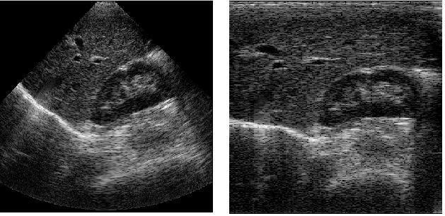 Figura 7. La figura 7 muestra la imagen de ultrasonido mostrada en el plano cartesiano (derecha) análogamente se muestra la imagen de ultrasonido en forma sectorial (izquierda).
