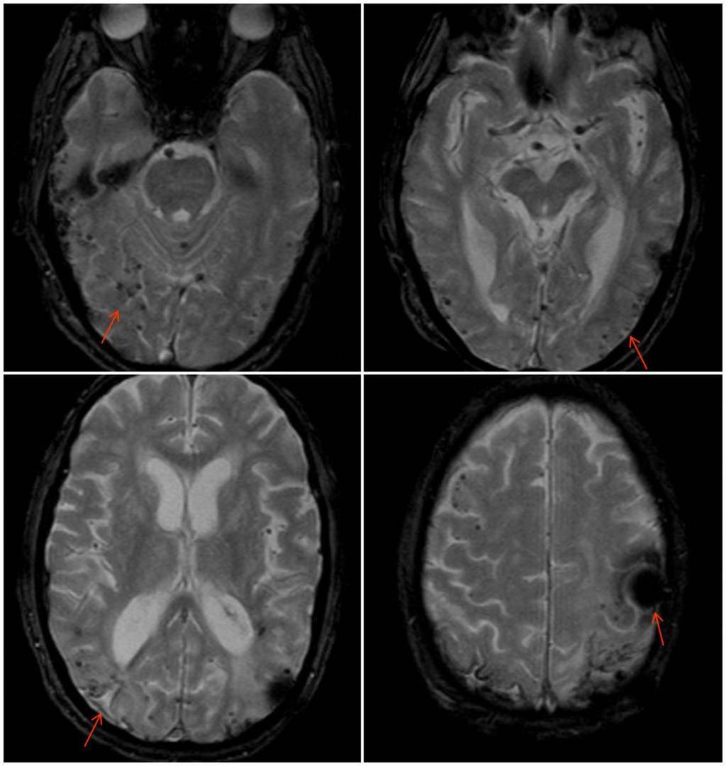 Fig. 3: Paciente de edad avanzada con diagnóstico de angiopatía amiloide cerebral.