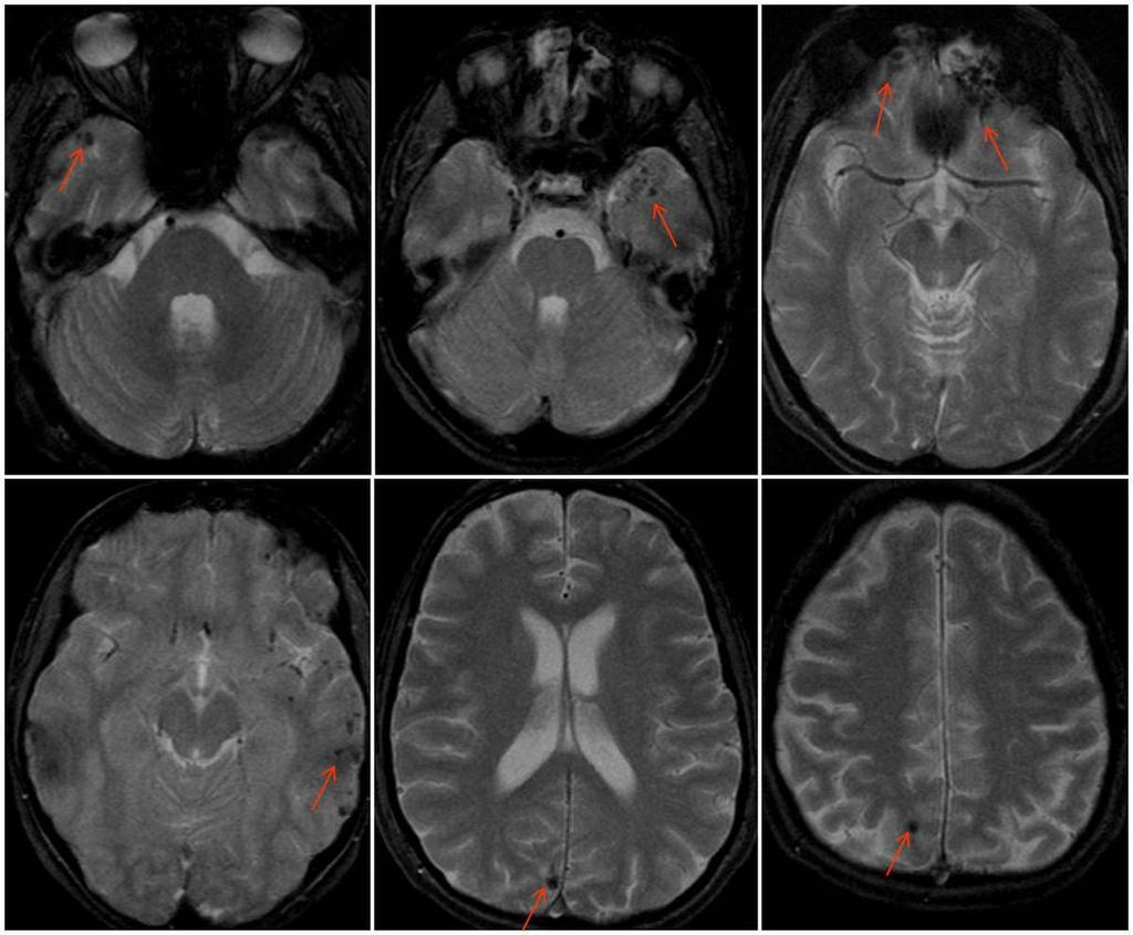 Fig. 9: Múltiples contusiones hemorrágicas corticales bilaterales en secuencia T2* en localizaciones típicas: polos temporales y regiones frontobasales.