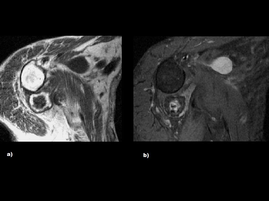Fig. 2: a) y b)- RM axiales en T1 y DP con SG donde se puede observar un cuerpo con medula ósea que