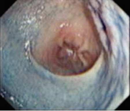 Tanimoto MA. et al. Figura 4. Cáncer gástrico incipiente en pared posterior del cuerpo (Lesión tipo IIa+IIc) con índigo carmín. Figura 5. Marcado de la periferia de la lesión.