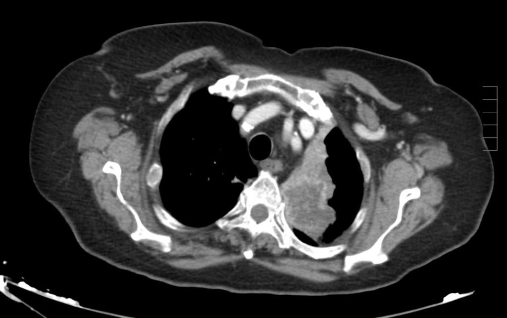 Fig. 11: Imagen de TC con contraste IV que muestra una lesión hipodensa