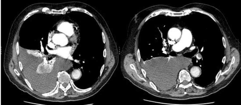 Fig. 14: Imagen de angiotc de arterias pulmonares a la izquierda se muestra un defecto de repleción en arterias