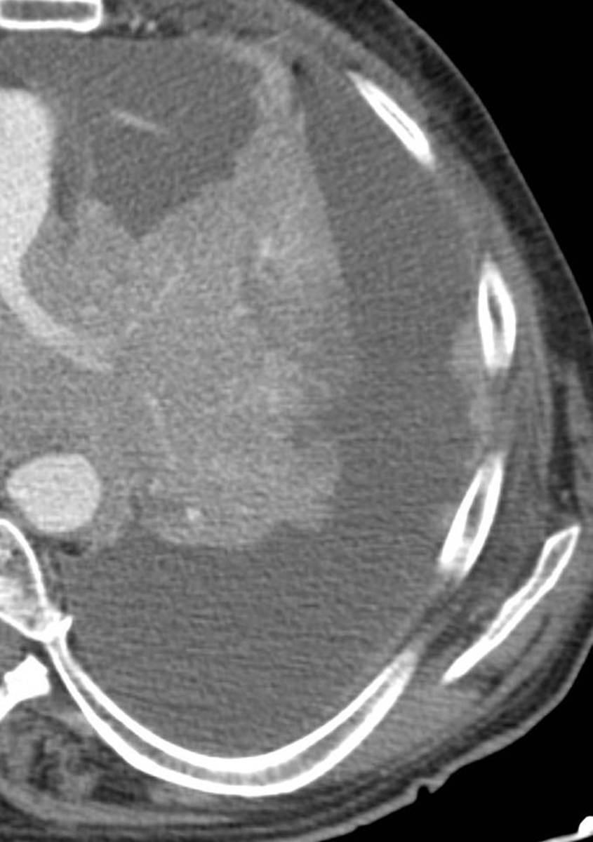 Fig. 3: Imagen de TC axial donde no se diferencia claramente la zona tumoral pero la