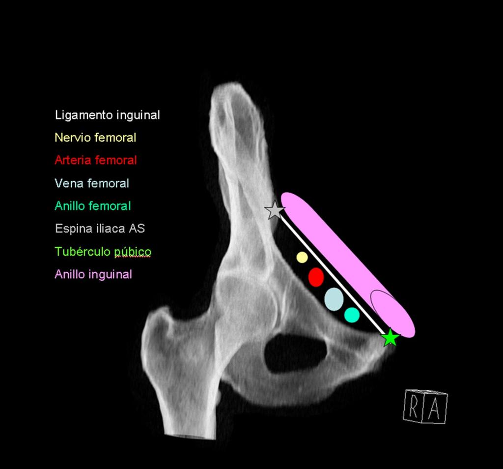 Fig. 2: Ligamento inguinal. Puntos de inserción: Espina iliaca anterosuperior y TP.