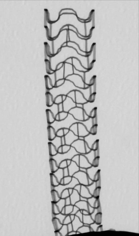 Stents