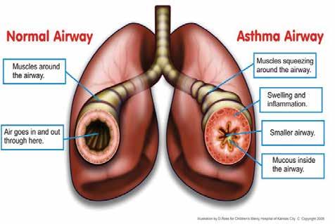 QUÉ PROVOCAN LOS SÍNTOMAS DE ASMA? Las vías respiratorias con asma son sensibles o pueden producir molestias fácilmente. Vías respiratorias normales Músculos alrededor de las vías respiratorias.