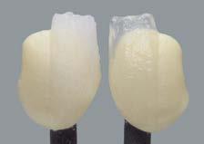 Resultado de la cocción Resultado de la cocción El resultado de la cocción de cerámica dental depende en gran medida del proceso concreto de cocción y de la conformación de la estructura por parte