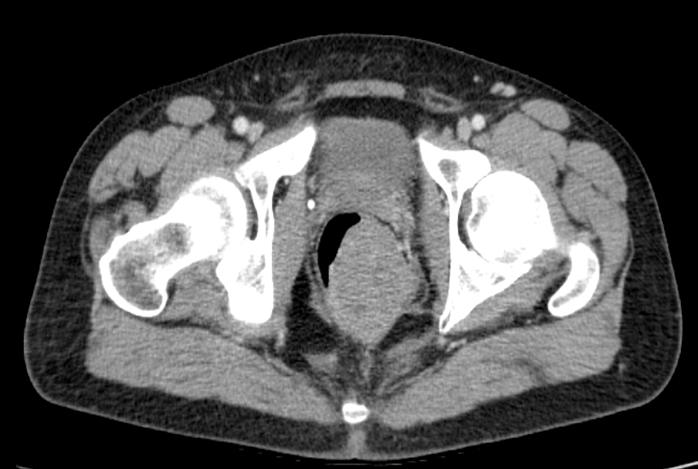Tumor gigante del estroma gastrointestinal rectal In rectal GIST tumors it is essential the multidisciplinary evaluation and treatment, in order to obtain the best possible results in this rare