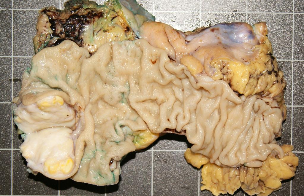 Tumor gigante del estroma gastrointestinal rectal Figura 4.