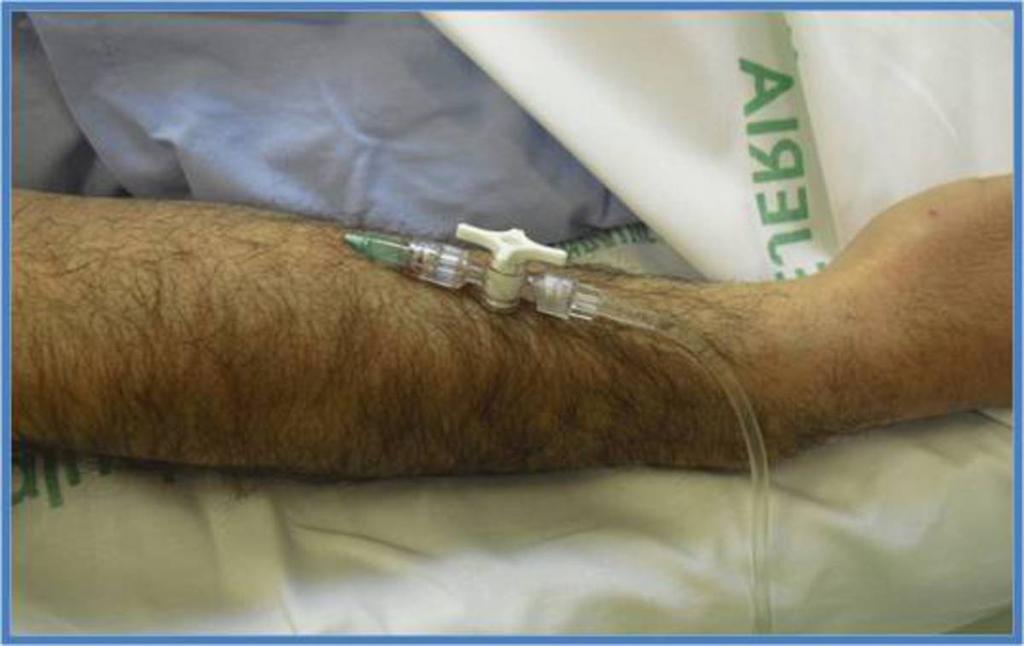 Fig. 3: Catéter intravenoso periférico para la introducción del