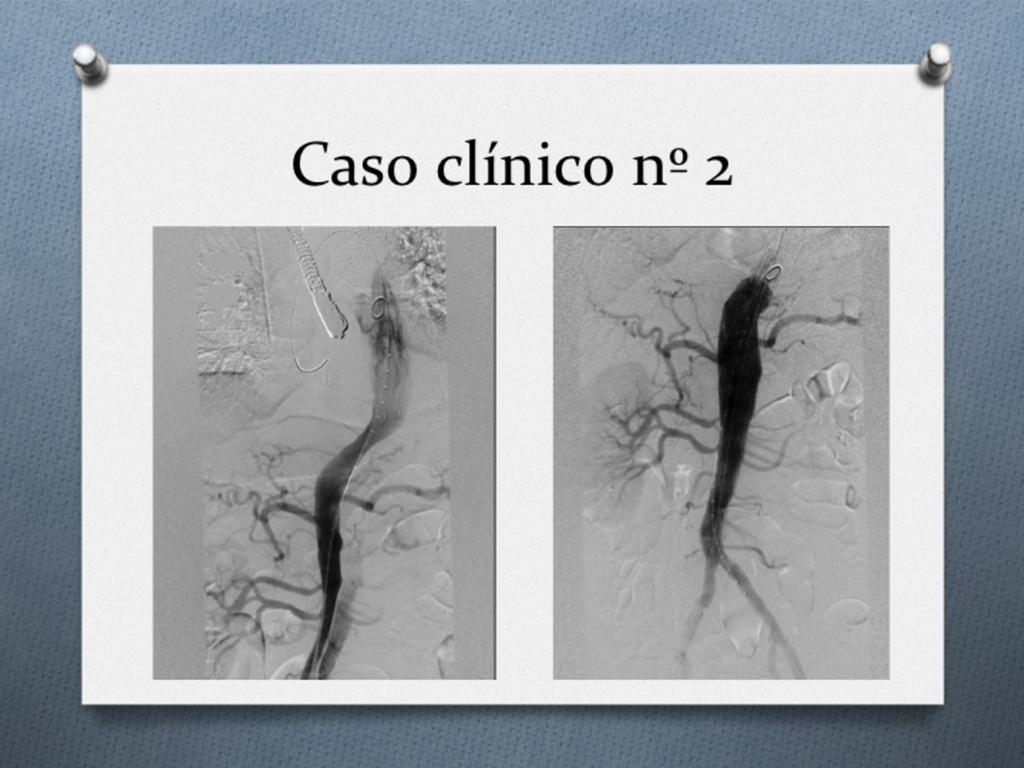 Fig. 15: Imágenes angiográficas que muestran la colocación de dos prótesis no cubiertas tipo Djumbodis