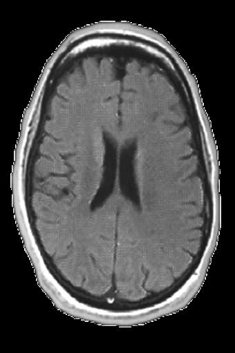 Atrofia cerebral en EM La atrofia cerebral es un biomarcador útil que