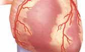 Si el músculo no recibe suficiente oxígeno, se pueden síntomas de angina. Si no se trata, la falta de oxígeno al músculo del corazón puede causar un ataque al corazón.