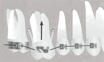 Intrusión unilateral del primer molar superior Se colocan microtornillos mesial y distal al 6.