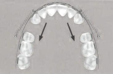 Retracción anterior en masa Protrusión bimaxilar bucal Clase II div. 1 Caso 2. Vestibular Se colocan dos microtornillos palatales entre 5 y 6.