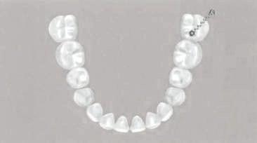 El uso del segundo microtornillo evita la rotación potencial durante el enderezamiento del molar.
