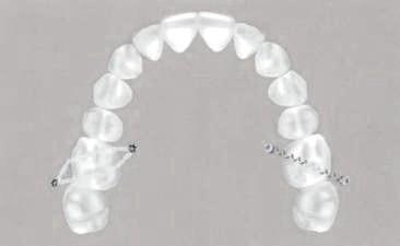 Intrusión molar Caso 2. Intrusión molar Molar superior izquierdo: Se usan dos microtornillos.