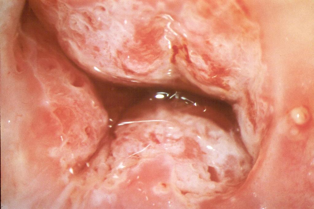 11 2. Una lesión veteada (en parches rojo y blanco) tipo zona de transformación ocupa el canal endocervical. Se pueden observar bocas glandulares grandes. Escisión confirmo AIS.