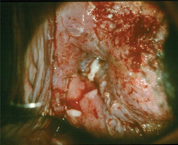 14 7. Las excrecencias papilares de este adenocarcinoma imitan a las vellosidades de una ectopia. La biopsia confirmo adenocarcinoma. 7 8.