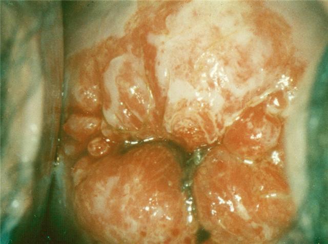 8 Referencias 1. Wright VC. Colposcopy of adenocarcinoma in situ and adenocarcinoma of the uterine cerviz: differentiation from other cervical lesions. J Lower Genital Tract Dis. 1999;2:83-87. 2.