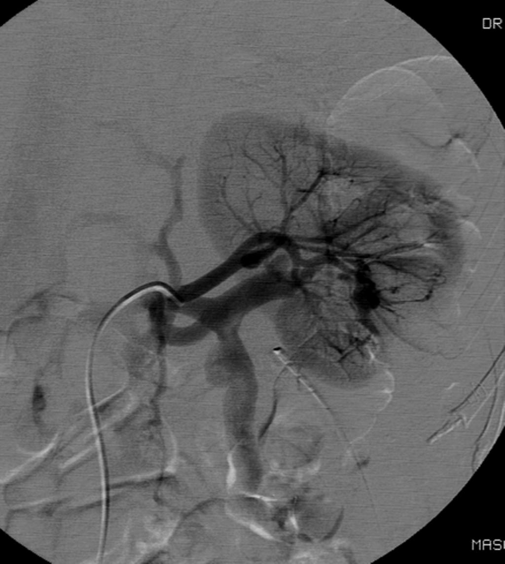 Fig. 4: Caso 2: Tumorectomía laparoscópica, polo inferior riñón izquierdo - Imagen 2: Arteriografía selectiva que confirma la presencia de pseudoaneurismas y fístulas arteriovenosas en