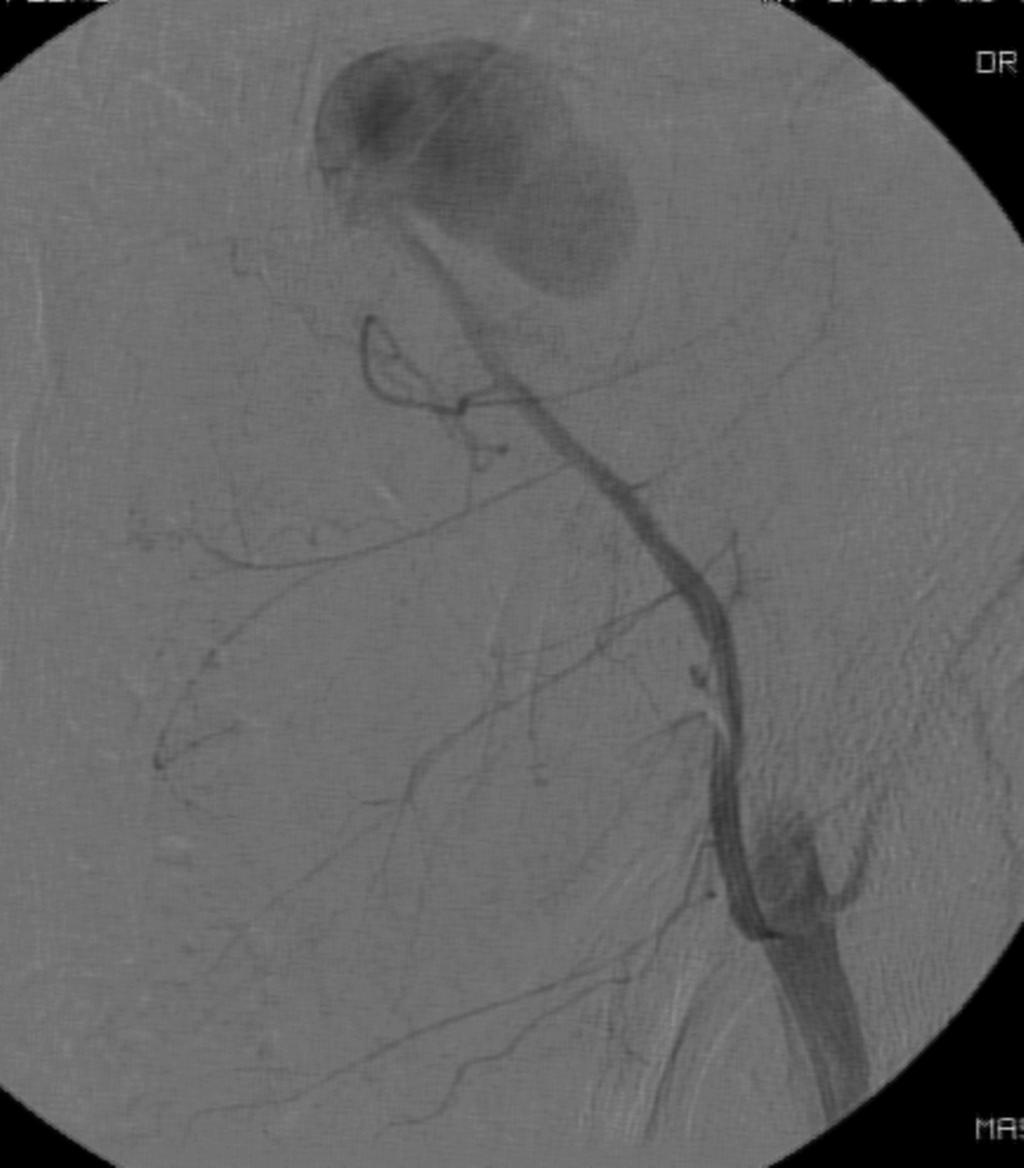 Fig. 6: Caso 3: Retirada de catéter de diálisis peritoneal - Imagen 1: Arteriografía selectiva de