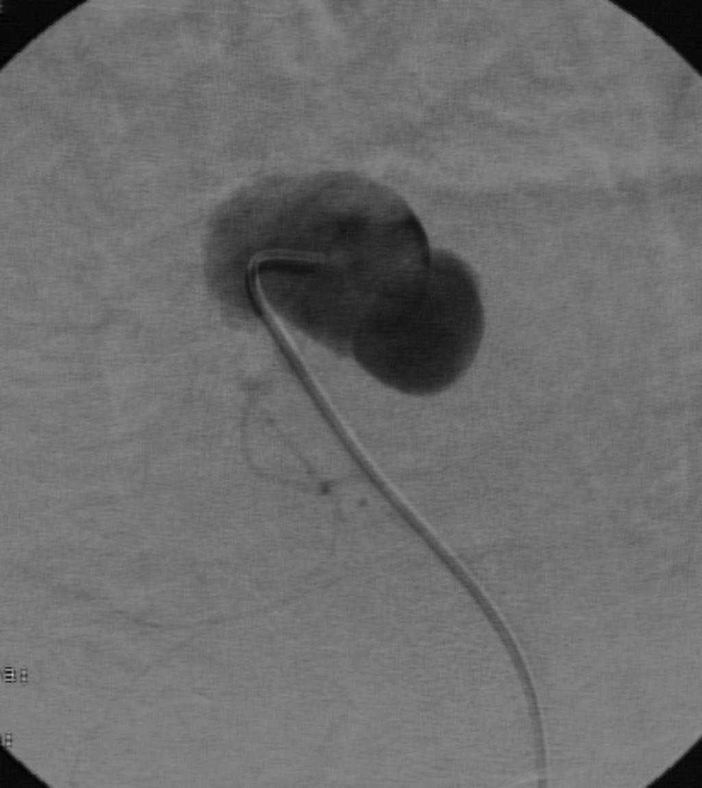 Fig. 7: Caso 3: Retirada de catéter de diálisis peritoneal - Imagen 2: Arteriografía supraselectiva