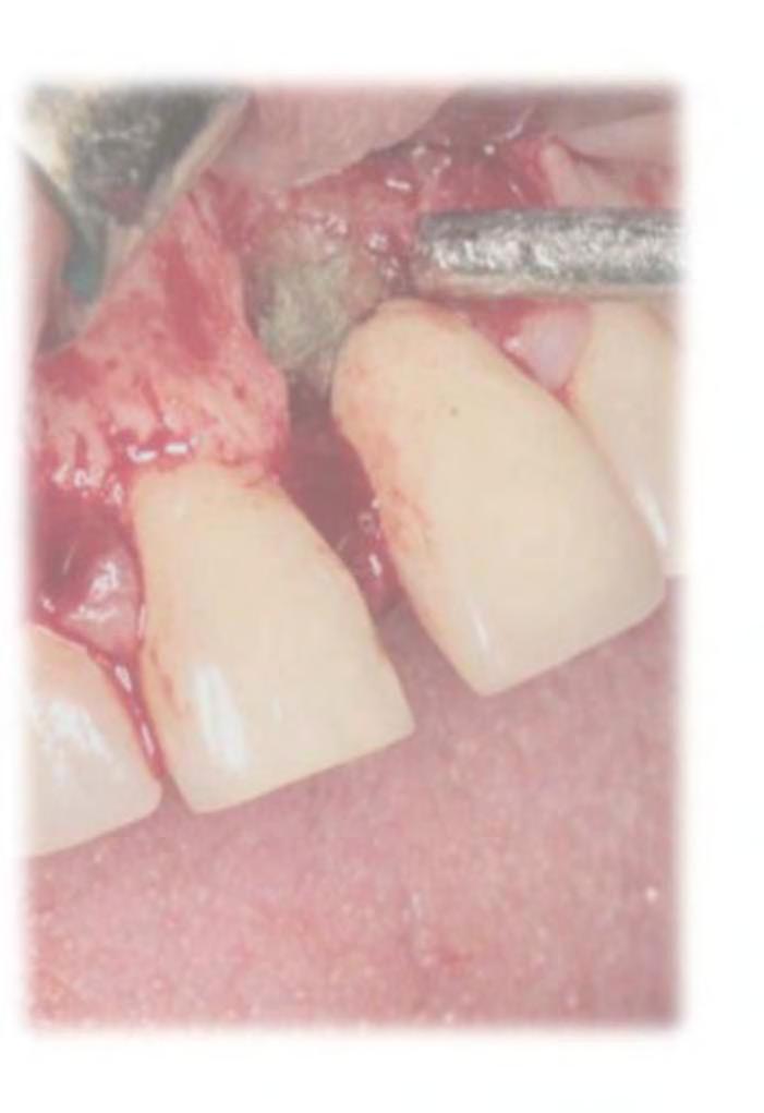 Caso clínico Cirugía correctiva diente 2.1 Dra.
