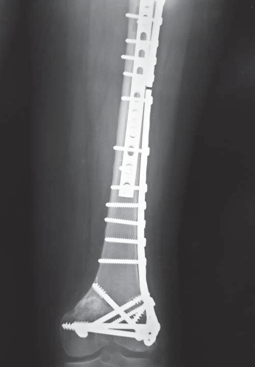 Figura 5. Radiografía convencional de control a los 12 meses del procedimiento quirúrgico en la que se puede constatar la osteointegración completa del aloinjerto.