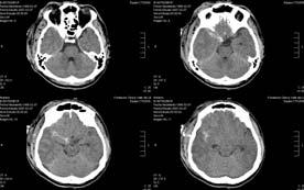 TAC de cráneo Inicial Cortes más altos, que muestran edema hemisférico, fractura parietal, esquirlas intracraneanas y contusión