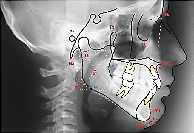 Grafico #1 Radiografía Cefalométrica Lateral que indica los puntos anatómicos cráneofaciales.