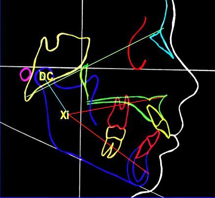 Grafico #3 Imagen lateral de la cara y cráneo donde se indican diversos planos y líneas cefalométricas.