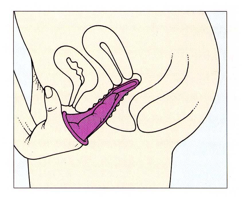 El preservativo femenino, 4 Introduce un dedo en el preservativo, y empújalo hasta el