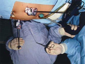 Dávila AF y cols. esofagogástrica durante la disección de los pilares del diafragma (Figuras 3 y 4). RESULTADOS Se pudo llevar a cabo el procedimiento en forma consecutiva en los 6 pacientes.