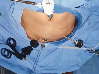 retractor hepático convencional. No hubo conversión a técnica laparoscópica tradicional.