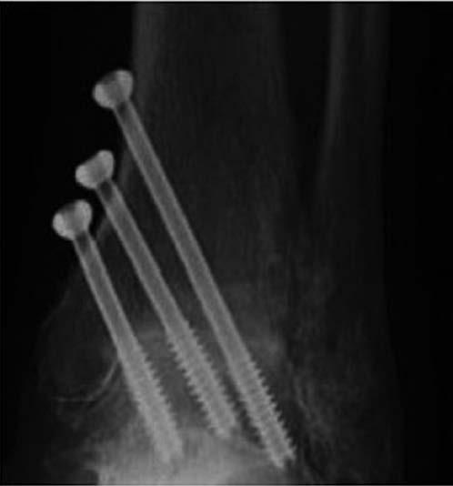 Artrodesis de tobillo en el paciente joven aproximadamente el 17% de los casos.