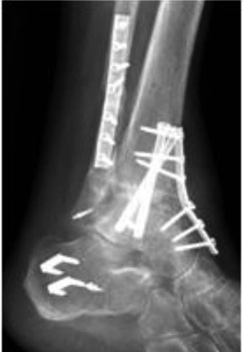 Artrodesis de tobillo en el paciente joven Artrodesis artroscópica Figura 4. Artrodesis tibioastragalina tras fracaso de artroplastia con tornillos canulados y placa anterior de neutralización.