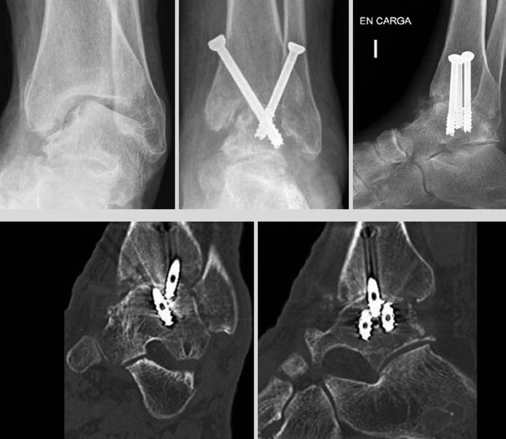 V. Vicent Carsí et al Figura 6. Artrodesis artroscópica de tobillo en paciente de 47 años. Varo importante preoperatorio.