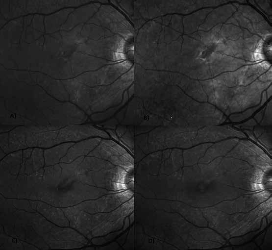 Utilidad de la imagen multimodal en el diagnóstico de las complicaciones del Síndrome de Grönblad-Stranberg con márgenes hiperautofluorescentes.