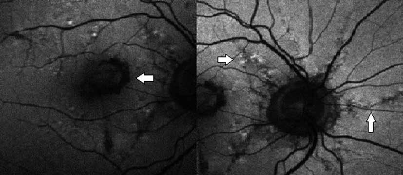 DURÁN CARRASCO O, et al. Fig. 4: Autofluorescencia OD; Izquierda: observamos hipoautofluorescencia correspondiente a la Hemorragia macular.