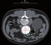Figura 2. Dispositivo Solopath en arteria femoral común derecha. Casos Paciente 1 Se trata de un paciente de 66 años, hipertenso, dislipémico, tabaquista.