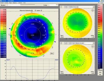 2. Topógrafo Easygraph ( Oculus) - Nos da información detallada de la superficie corneal, al inicio y durante el