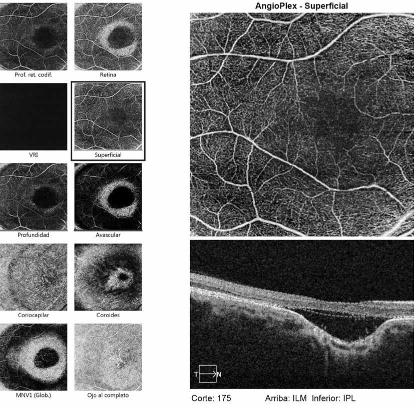 PEÑATE-SANTANA H, et al. Fig. 5: Angio- OCT de OD caso 1. indicación, en cada ojo con periodicidad de 1 mes.